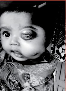 A child with Oral Cancer