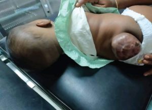 An infant with a tumor in her lumber area.