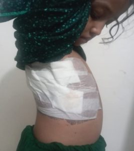 A little girl with bandage in her left side of chest.