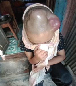 Girl with tumor in her head.